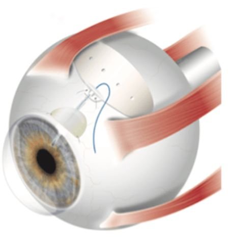 Glaucoma